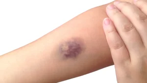 رفع کبودی و التهاب پوست