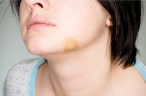 کبودی چانه و راهکارهای بهبود آن